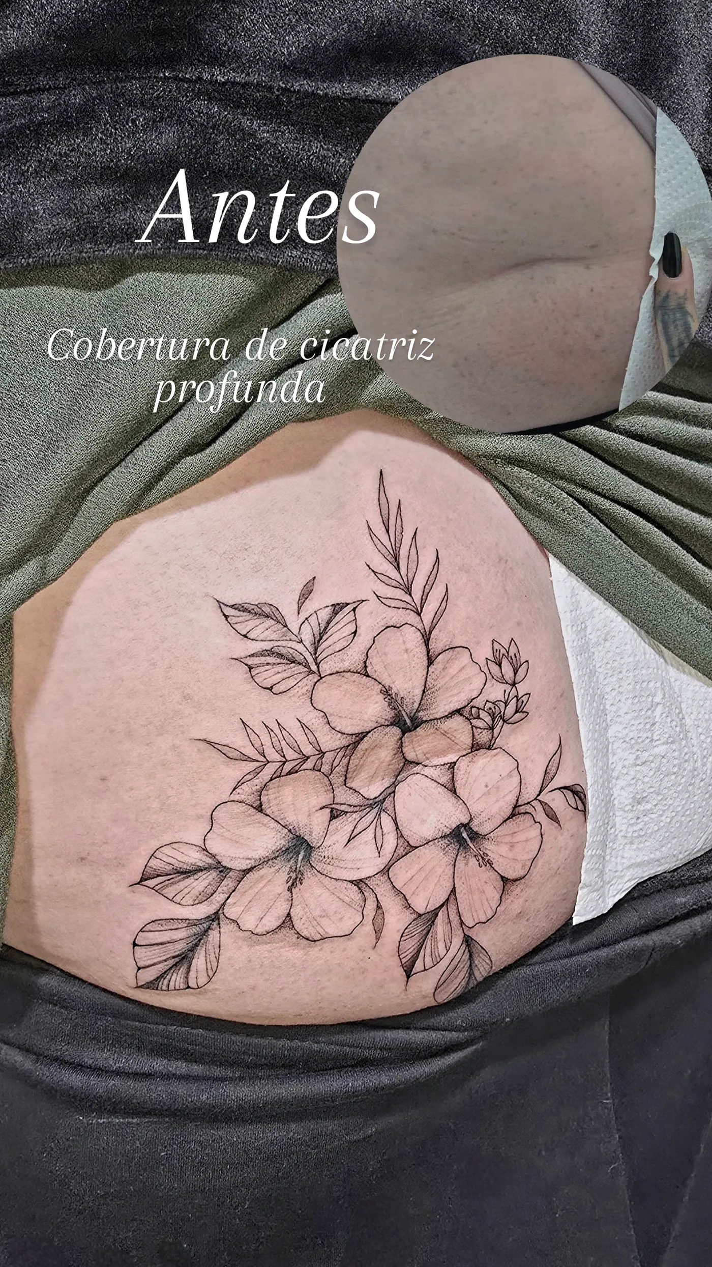 Cobertura de cicatriz profunda com composição floral